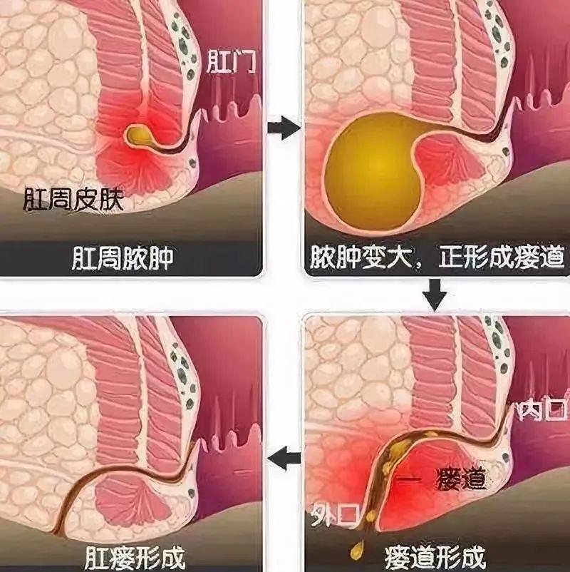 肛瘘的最新治疗方法,实践说明解析_R版35.67.65