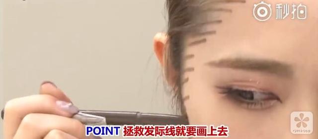 最新种发际线技术，重塑美丽容颜的优选选择